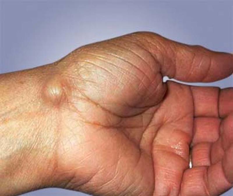 The reason a ganglion cyst may appear can be difficult to determine, as the...