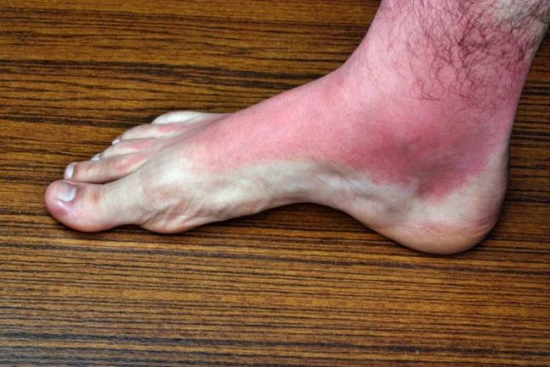 warning-signs-of-a-blood-clot-that-can-t-be-ignored