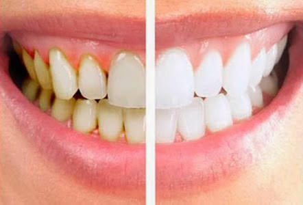 Mixtures That Completely Remove Tartar from Your Teeth